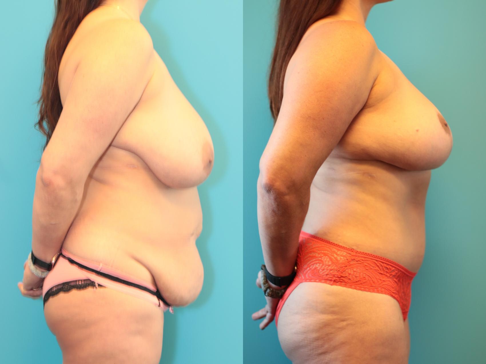 Before & After Tummy Tuck Case 275 Right Side View in West Des Moines, IA