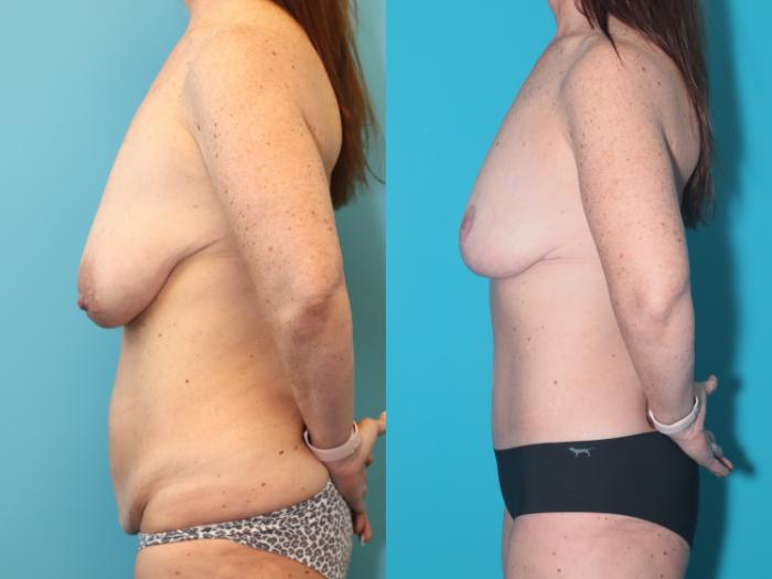 Before & After Tummy Tuck Case 289 Left Side View in West Des Moines, IA
