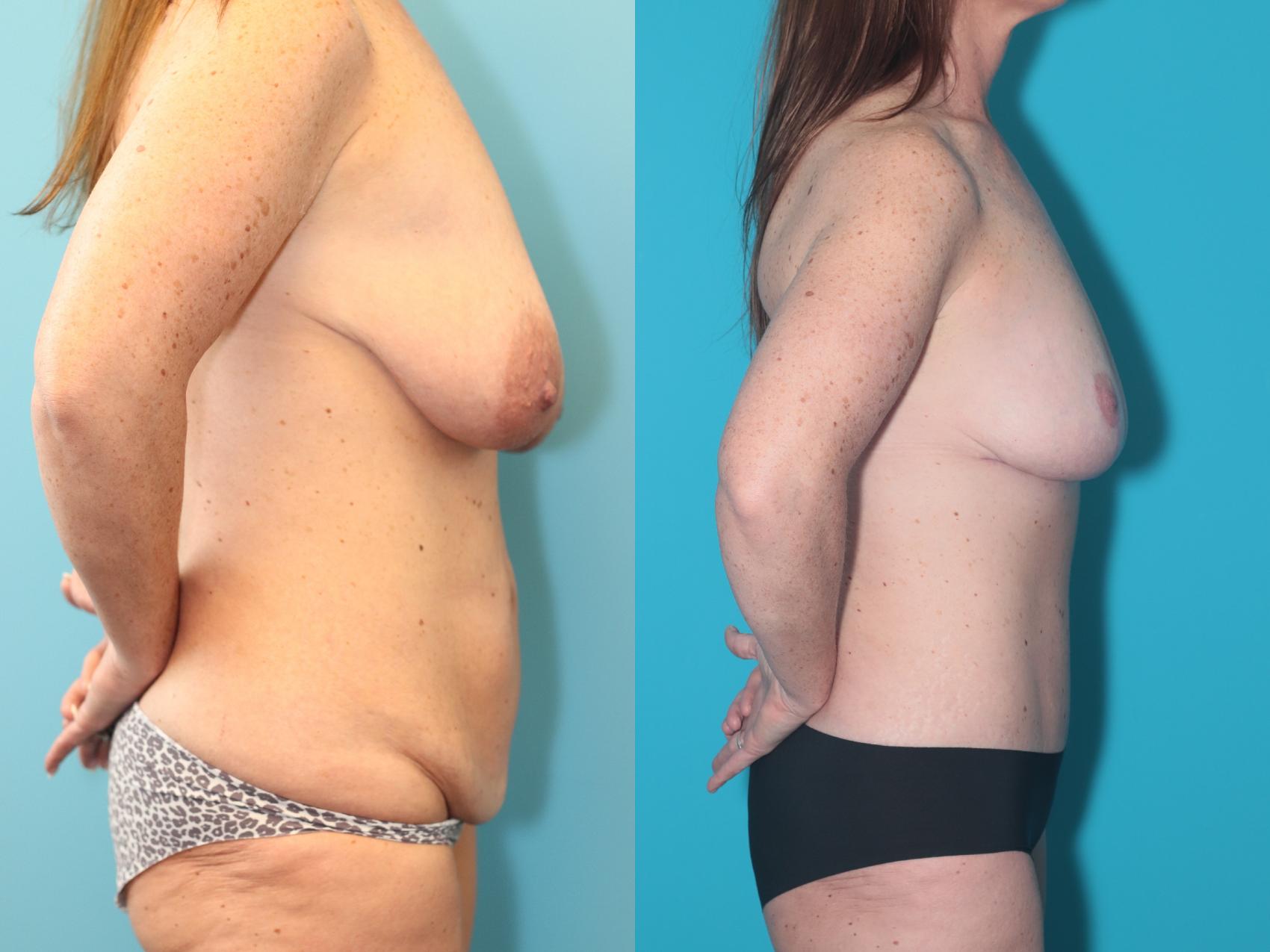 Before & After Tummy Tuck Case 289 Right Side View in West Des Moines, IA