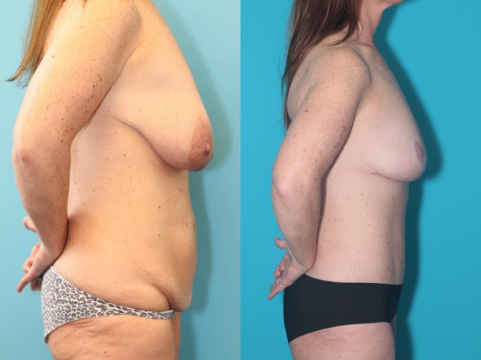 Before & After Tummy Tuck Case 289 Right Side View in West Des Moines, IA