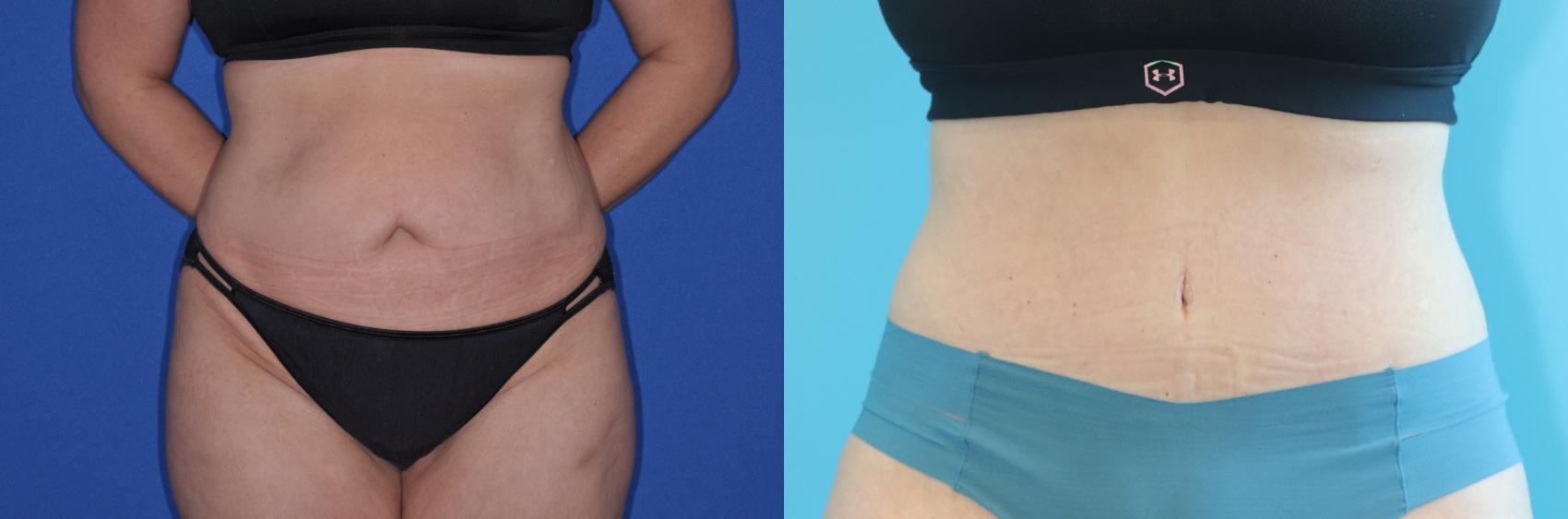 Before & After Tummy Tuck Case 293 Front View in West Des Moines, IA