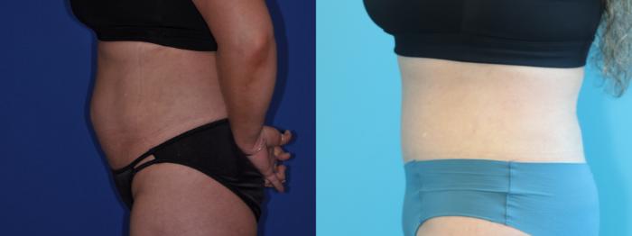 Before & After Tummy Tuck Case 293 Left Side View in West Des Moines & Ames, IA