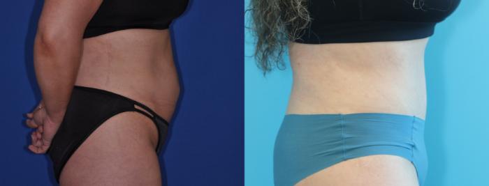 Before & After Tummy Tuck Case 293 Right Side View in West Des Moines & Ames, IA