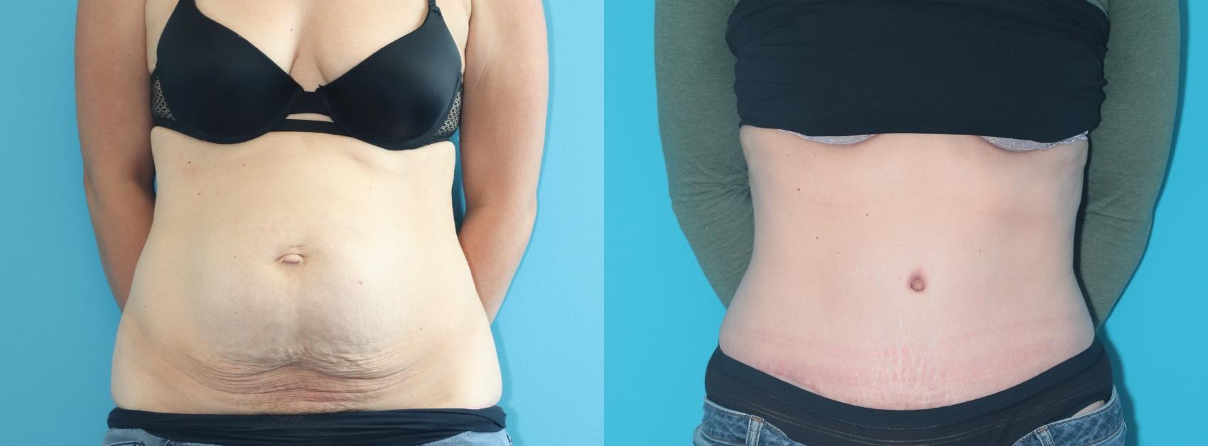 Before & After Tummy Tuck Case 298 Front View in West Des Moines, IA