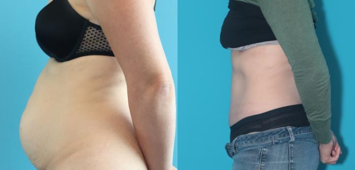 Before & After Tummy Tuck Case 298 Left Side View in West Des Moines & Ames, IA
