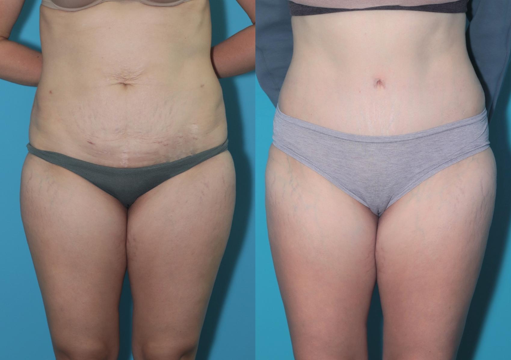 Before & After Tummy Tuck Case 300 Front View in West Des Moines, IA