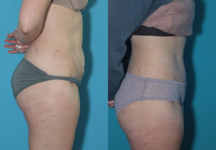 Before & After Tummy Tuck Case 300 Right Side View in West Des Moines & Ames, IA