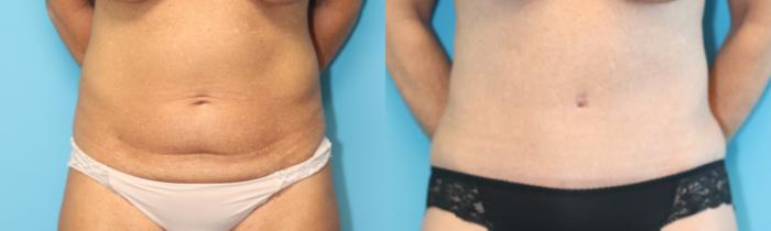 Before & After Tummy Tuck Case 315 Front View in West Des Moines, IA