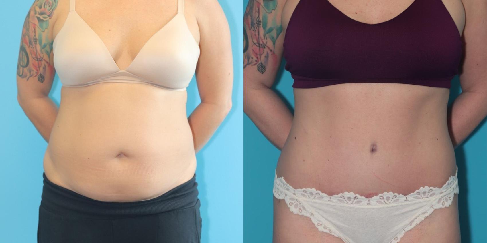 tummy-tuck-before-and-after-pictures-case-325-west-des-moines-ia