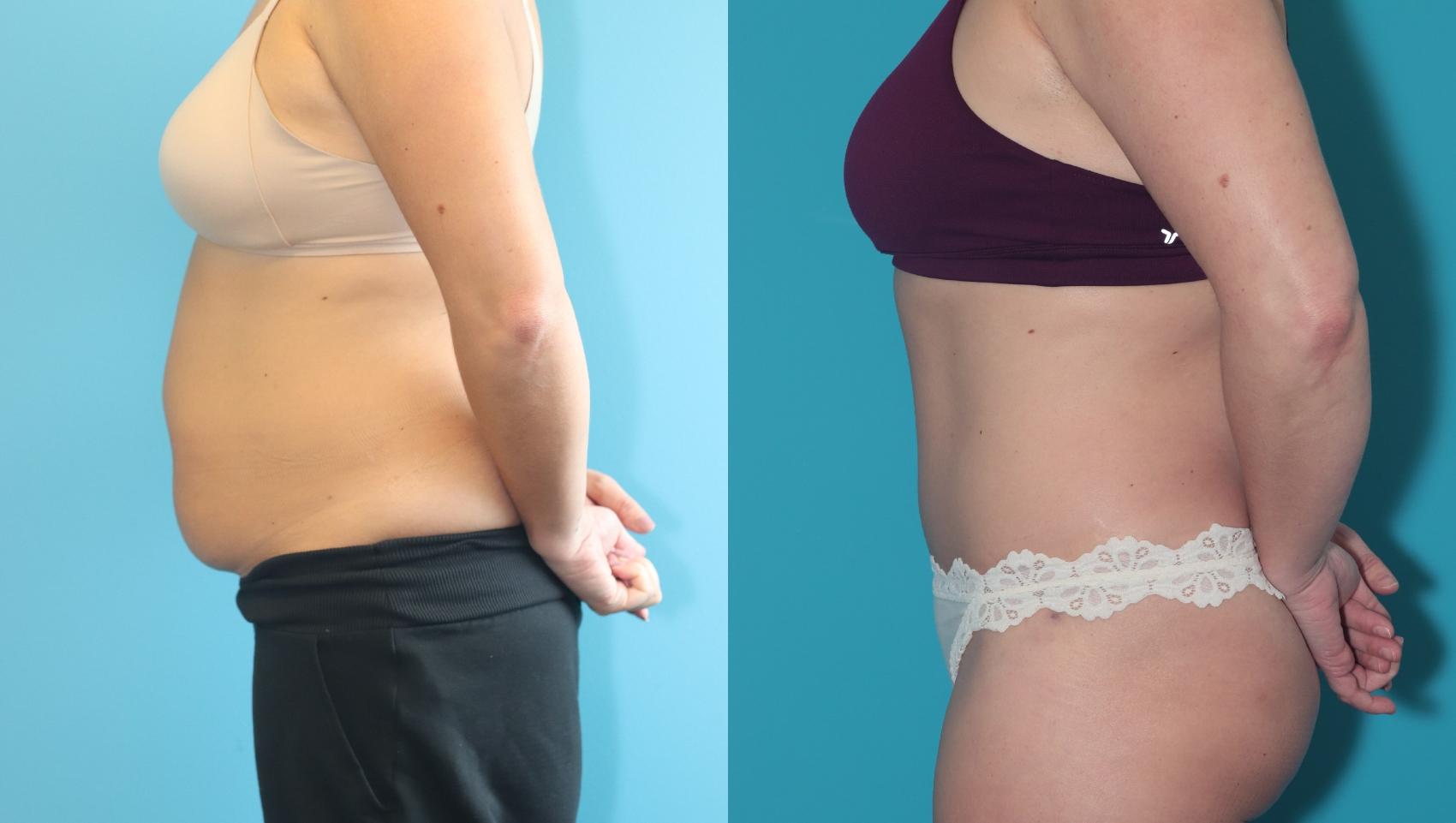 Before & After Liposuction/ Fat Transfer/ Brazilian Butt Lift Case 325 Left Side View in West Des Moines & Ames, IA