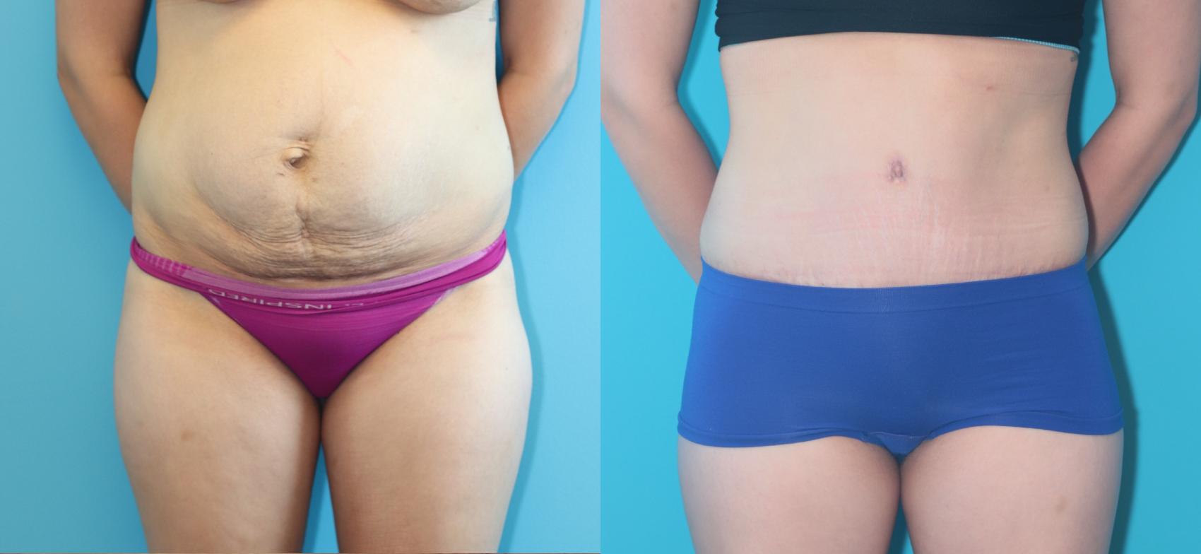 Before & After Tummy Tuck Case 342 Front View in West Des Moines & Ames, IA