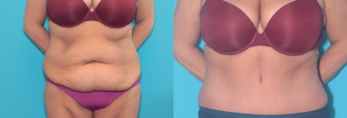 Before & After Tummy Tuck Case 352 Front View in West Des Moines & Ames, IA