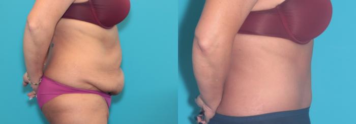 Before & After Tummy Tuck Case 352 Right Side View in West Des Moines & Ames, IA
