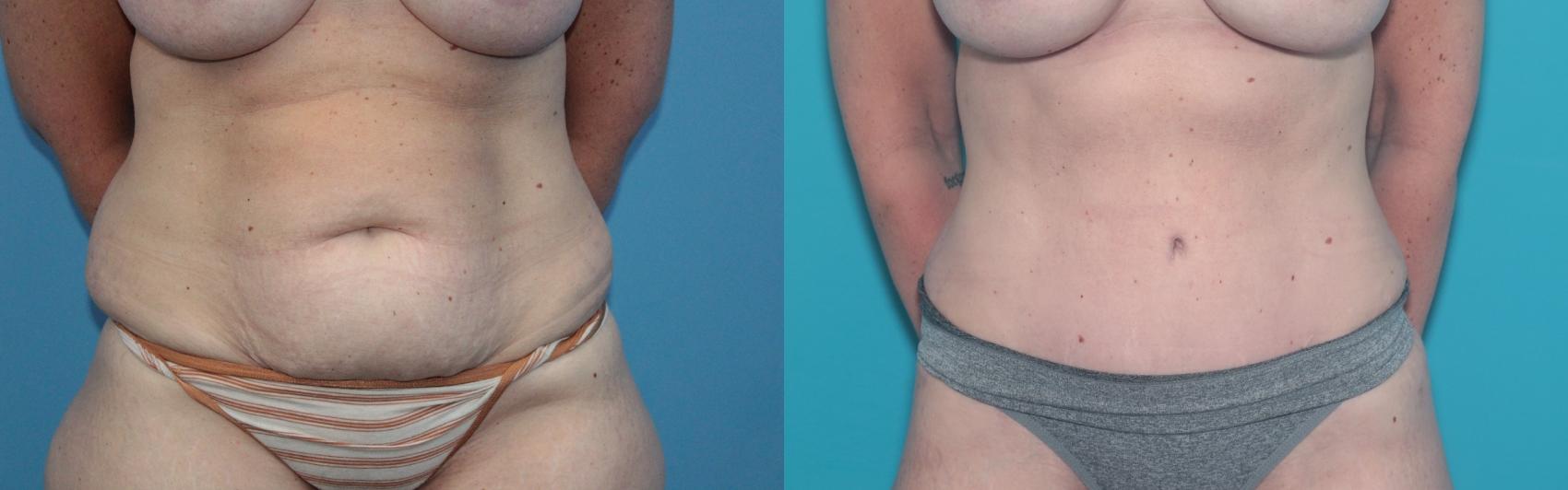 Before & After Tummy Tuck Case 353 Front View in West Des Moines & Ames, IA