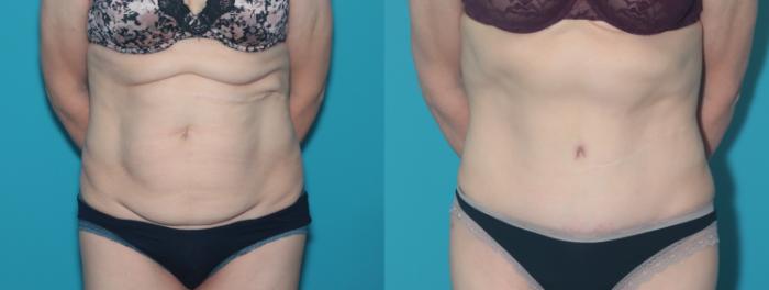Before & After Tummy Tuck Case 356 Front View in West Des Moines & Ames, IA