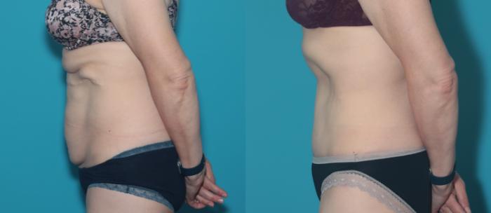 Before & After Tummy Tuck Case 356 Left Side View in West Des Moines & Ames, IA