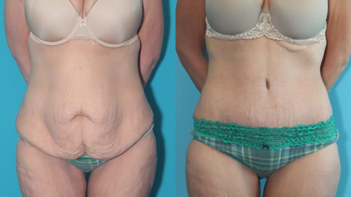 Before & After Tummy Tuck Case 369 Front View in West Des Moines & Ames, IA