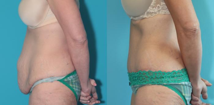 Before & After Tummy Tuck Case 369 Left Side View in West Des Moines & Ames, IA