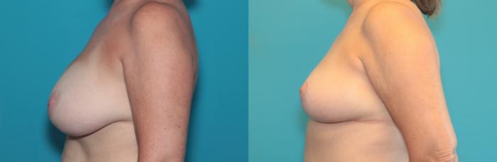Before & After Breast Reduction Case 372 Left Side View in West Des Moines & Ames, IA