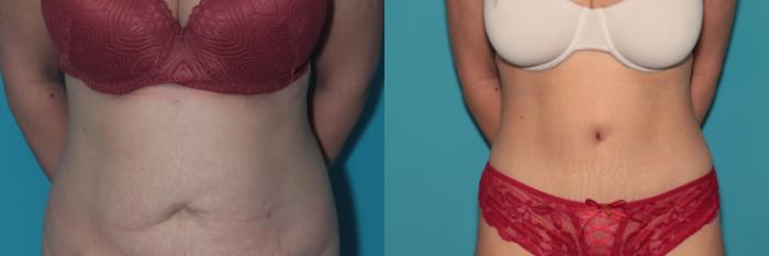 Before & After Tummy Tuck Case 385 Front View in West Des Moines & Ames, IA