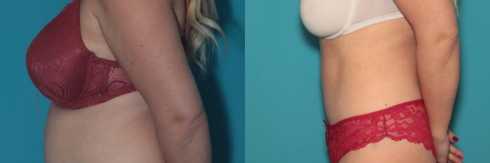 Before & After Tummy Tuck Case 385 Left Side View in West Des Moines & Ames, IA