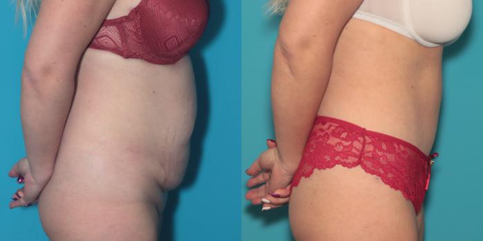 Before & After Tummy Tuck Case 385 Right Side View in West Des Moines & Ames, IA