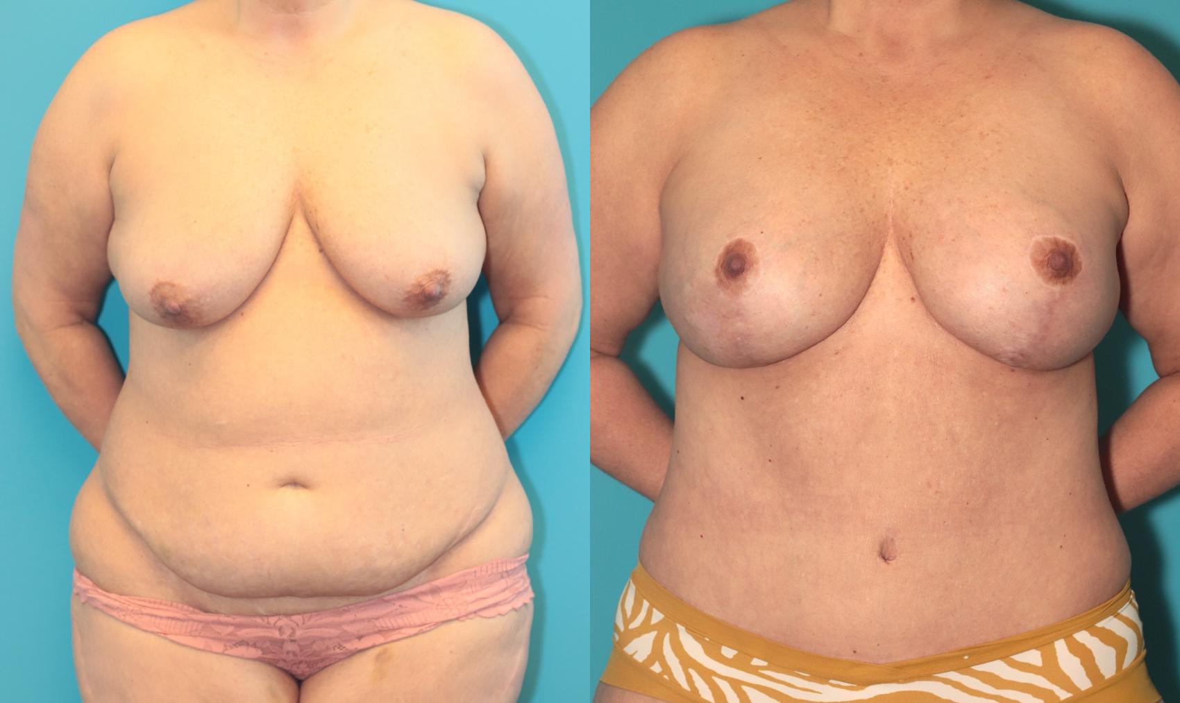 Before & After Tummy Tuck Case 387 Front View in West Des Moines, IA