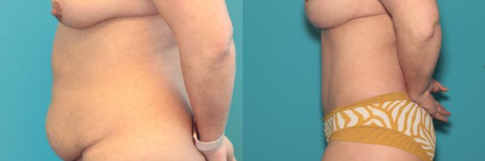 Before & After Tummy Tuck Case 387 Left Side View in West Des Moines & Ames, IA