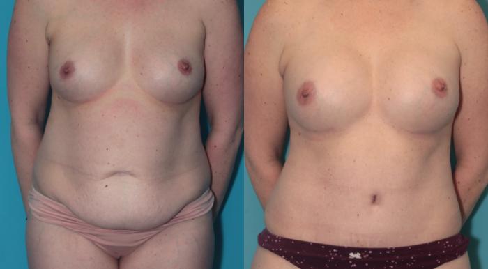 Before & After Tummy Tuck Case 388 Front View in West Des Moines & Ames, IA