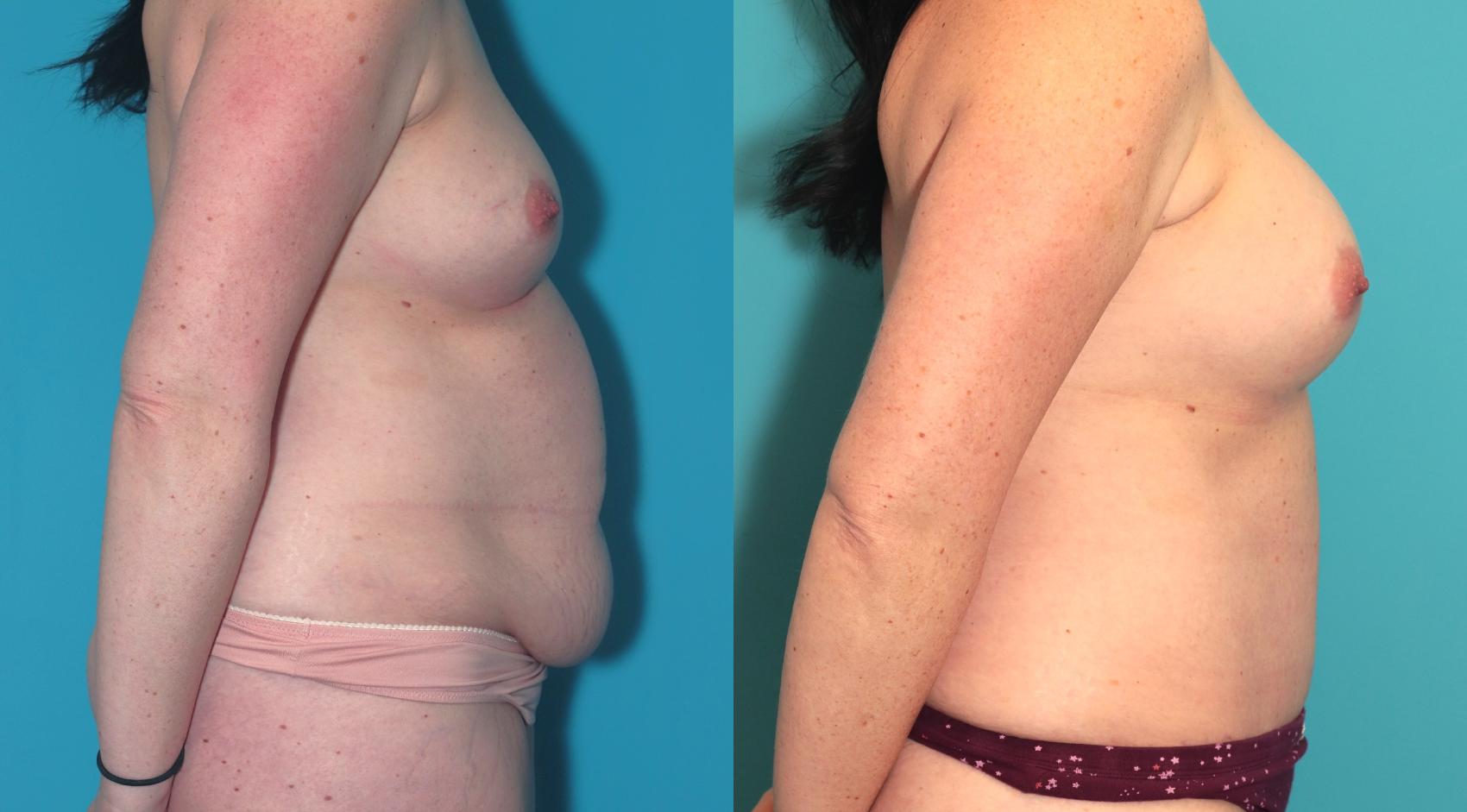 Before & After Tummy Tuck Case 388 Right Side View in West Des Moines & Ames, IA