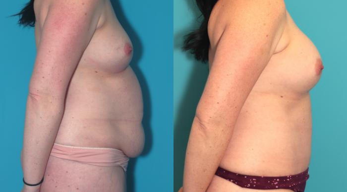 Before & After Tummy Tuck Case 388 Right Side View in West Des Moines & Ames, IA