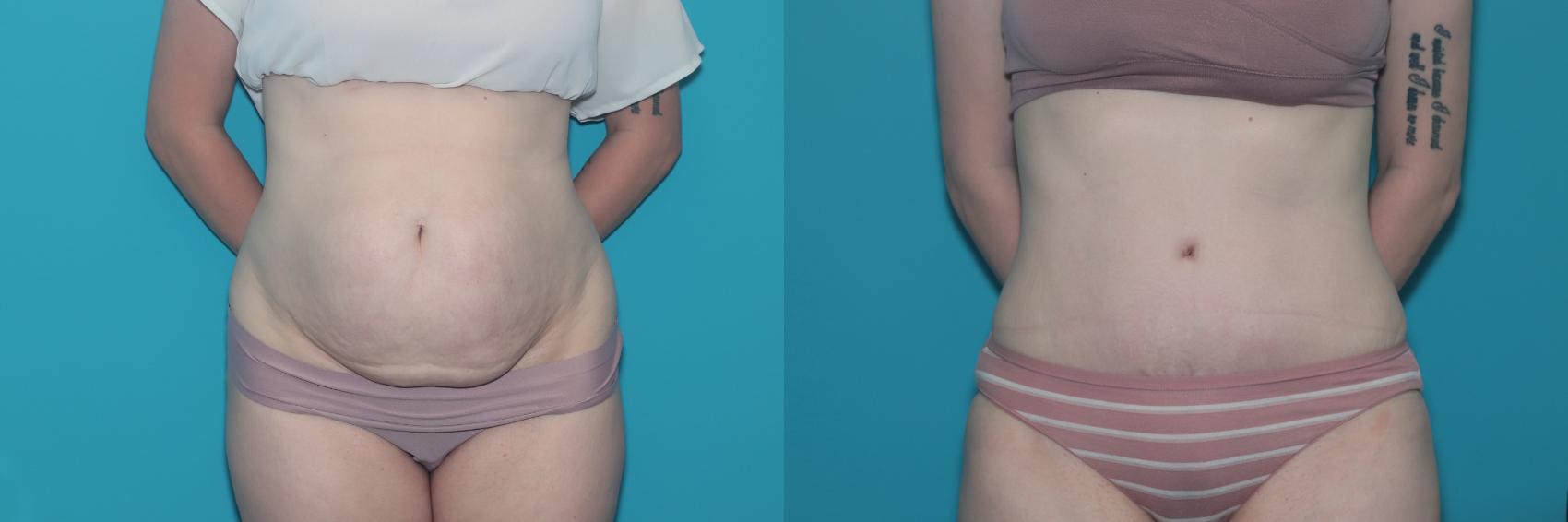 Before & After Tummy Tuck Case 422 Front View in West Des Moines & Ames, IA