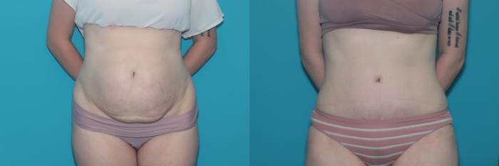 Before & After Liposuction/ Fat Transfer/ Brazilian Butt Lift Case 422 Front View in West Des Moines & Ames, IA