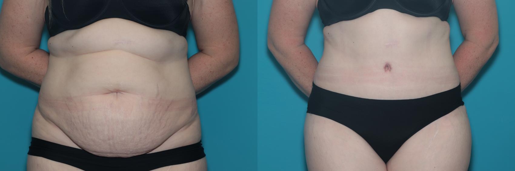 Before & After Tummy Tuck Case 429 Front View in West Des Moines & Ames, IA