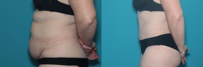 Before & After Tummy Tuck Case 429 Left Side View in West Des Moines & Ames, IA