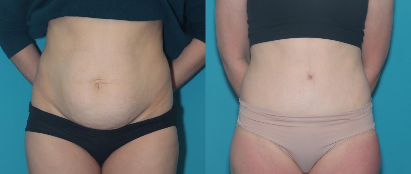 Before & After Tummy Tuck Case 440 Front View in West Des Moines & Ames, IA