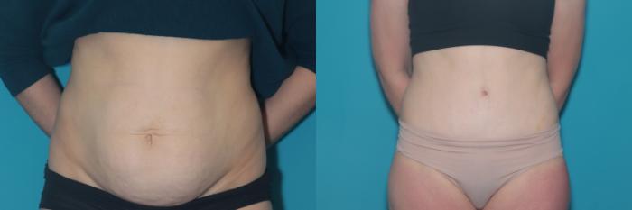 Before & After Liposuction/ Fat Transfer/ Brazilian Butt Lift Case 440 Front View in West Des Moines & Ames, IA
