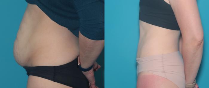 Before & After Tummy Tuck Case 440 Left Side View in West Des Moines & Ames, IA