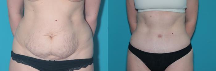 Before & After Tummy Tuck Case 450 Front View in West Des Moines & Ames, IA