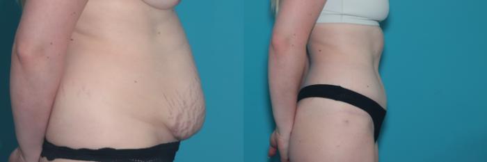 Before & After Tummy Tuck Case 450 Right Side View in West Des Moines & Ames, IA