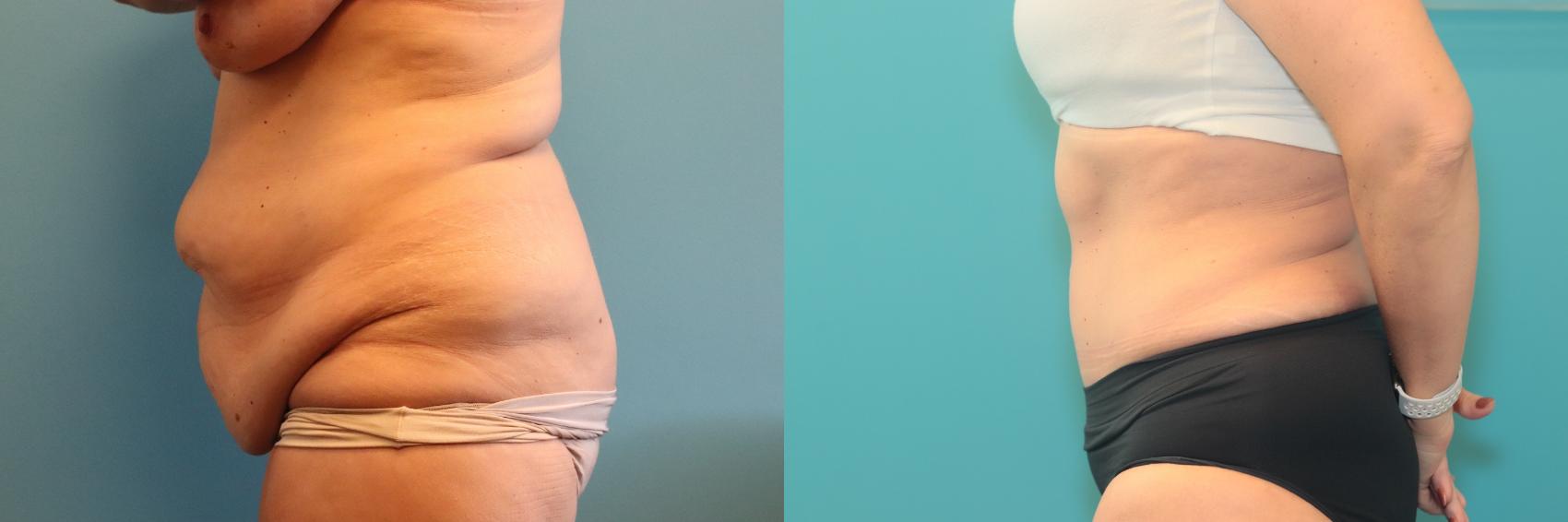 Before & After Tummy Tuck Case 460 Left Side View in West Des Moines & Ames, IA