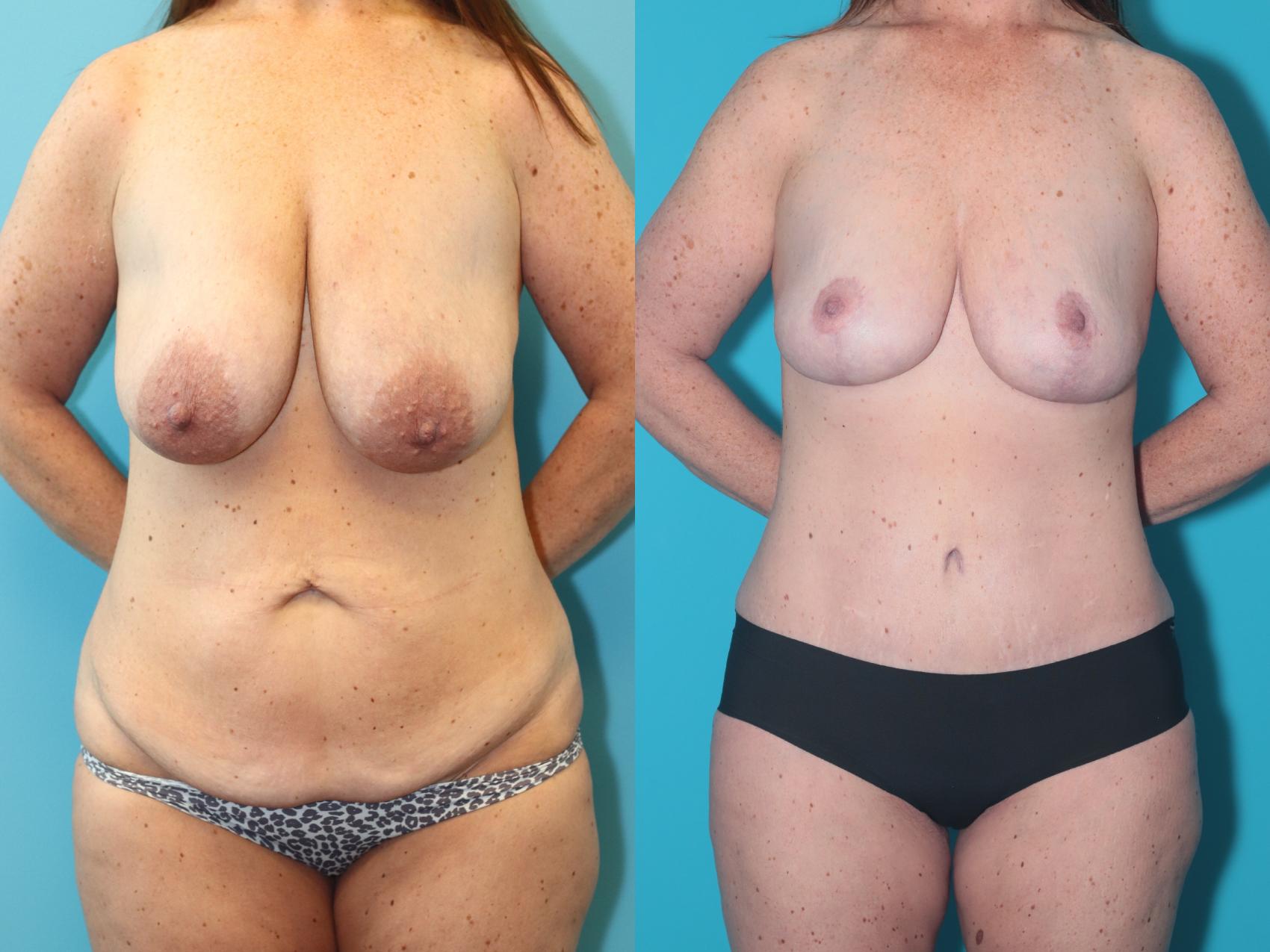 Before & After Tummy Tuck Case 471 Front View in West Des Moines & Ames, IA