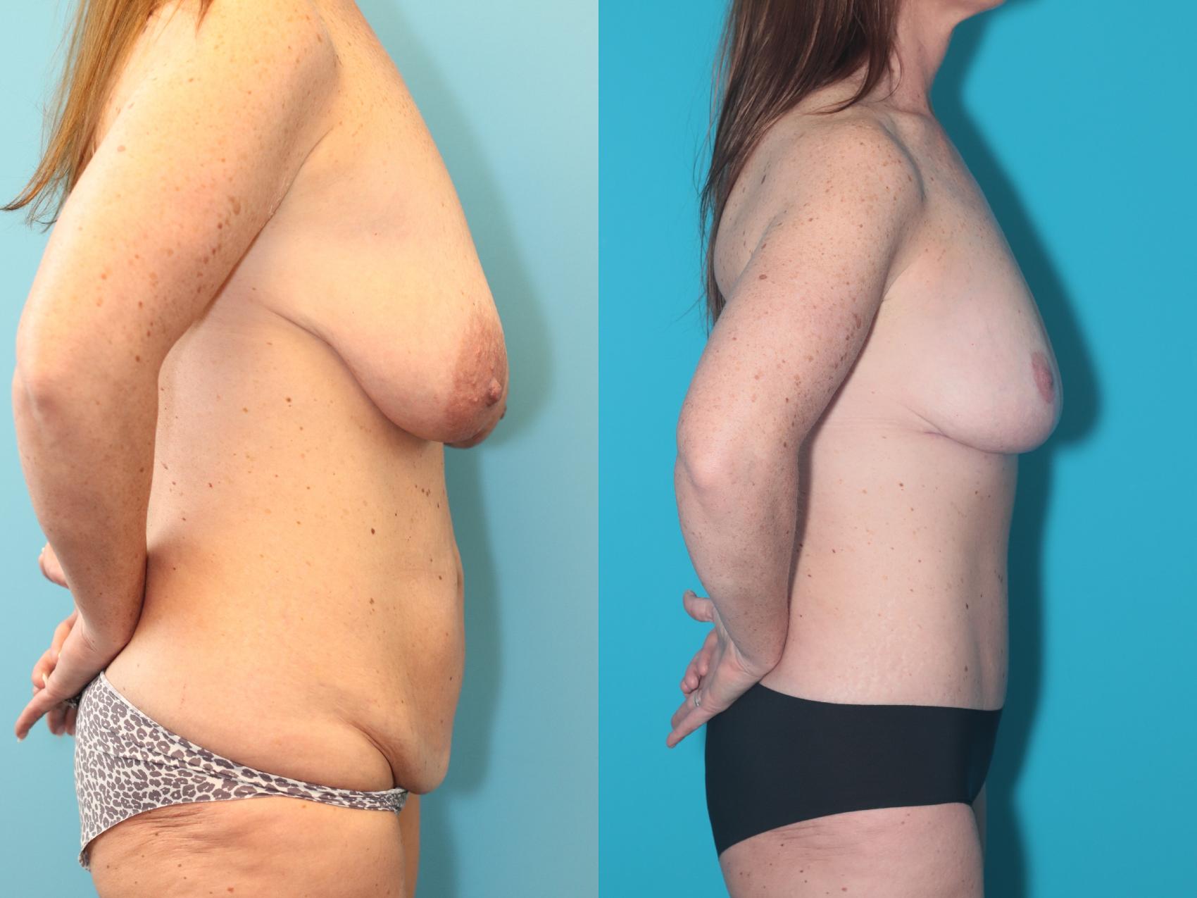 Before & After Tummy Tuck Case 471 Left Side View in West Des Moines & Ames, IA