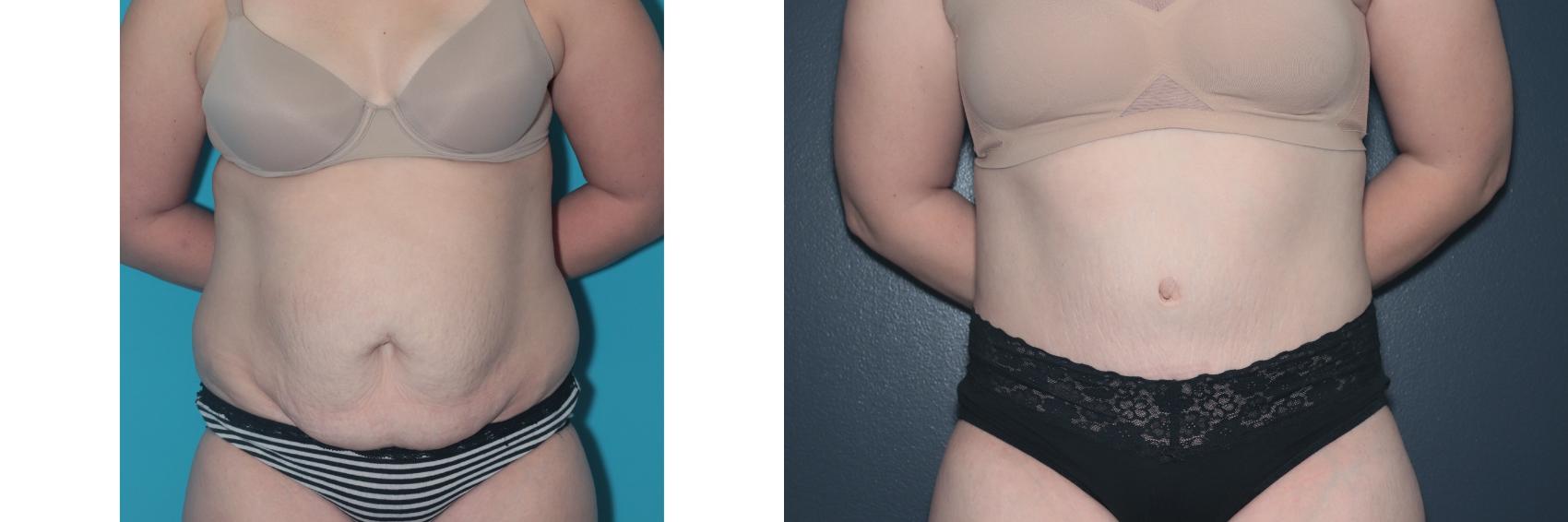 Before & After Tummy Tuck Case 478 Front View in West Des Moines & Ames, IA