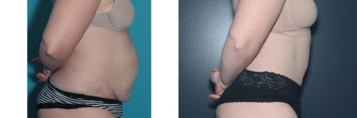 Before & After Tummy Tuck Case 478 Right Side View in West Des Moines & Ames, IA