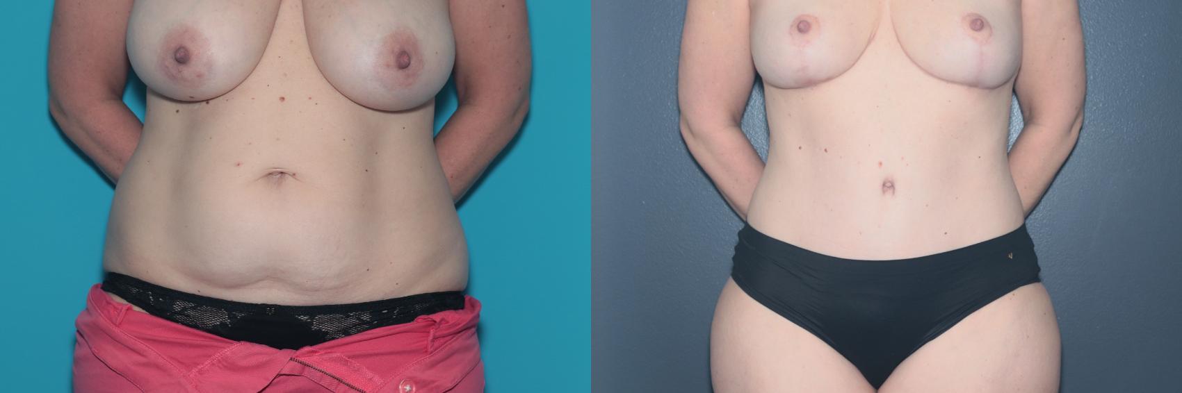 Before & After Tummy Tuck Case 497 Front View in West Des Moines & Ames, IA