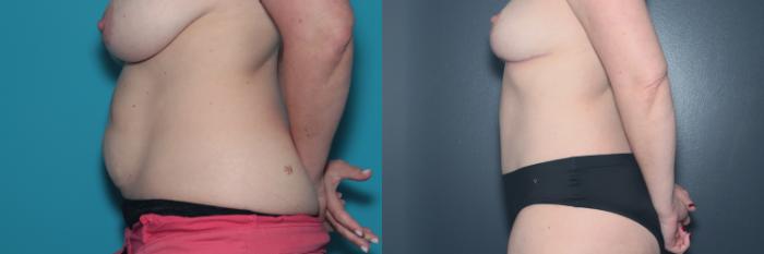 Before & After Tummy Tuck Case 497 Left Side View in West Des Moines & Ames, IA