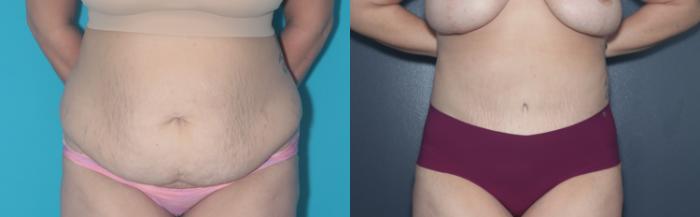 Before & After Tummy Tuck Case 505 Front View in West Des Moines & Ames, IA