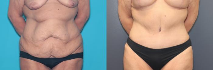 Before & After Tummy Tuck Case 508 Front View in West Des Moines & Ames, IA