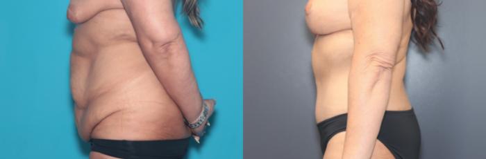 Before & After Tummy Tuck Case 508 Right Side View in West Des Moines & Ames, IA